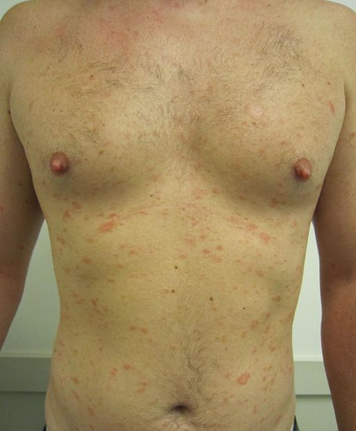 Röschenflechte (Pityriasis rosea) von vorne